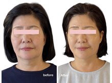 美容鍼(電気あり)施術回数7回目:たるみ、口角共に引き上がり☆