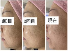 ペルボヌール 深井店/本気の肌質改善ハーブピーリング