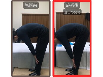 まこと整骨院/尻もち後の激烈な腰痛の整体　２