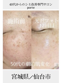ポルテ バイ ハルモ(porte by Harmo)/porte式シミケアメソッド！