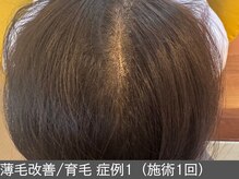 オアシスラグーン(OASIS LAGOON)/育毛促進（症例1施術1回）