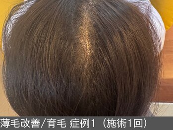 オアシスラグーン(OASIS LAGOON)/育毛促進(症例1施術1回)