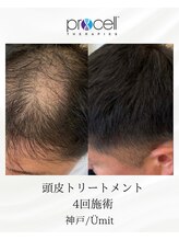 ユミト(Umit)/プロセルスカルプ