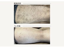 クレビア(CREVIA)/メンズあし脱毛◆BeforeAfter