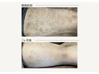 クレビア(CREVIA)/メンズあし脱毛◆BeforeAfter