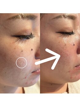 エミナル(Eminal)/◇毛穴エクストラクションtete式