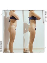 スキンホリック 恵比寿駅前店(SKIN HOLIC)/ブライダル痩身ビフォア＆アフタ