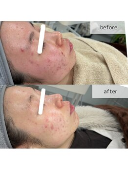 ヴィーナス(Venus)/エステ版ポテンツァ　3回