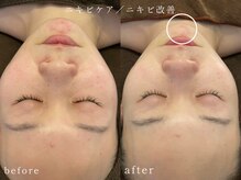 オヤム(oyam)/《毛穴洗浄》