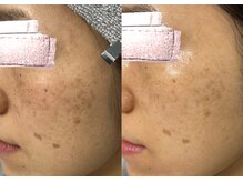 モガナ(mogana)/シミケア×赤ちゃん肌ピーリング