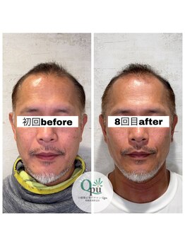 キュープ 相模原淵野辺店(Qpu)/たった4回で人生で1番小さな顔に