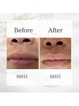 サロン ルイ(salonRui)/ひげ脱毛　before　afuta