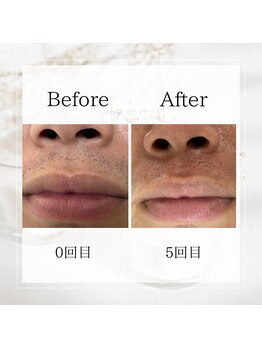 サロン ルイ(salonRui)/ひげ脱毛　before　afuta