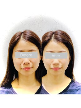 ワカヤマ 小顔(Wakayama)/★Before・After★