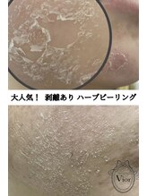 ヴィオール 名古屋栄店(VIOR) 剥離あり ピーリング