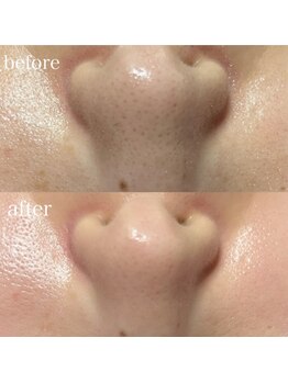 薫風/毛穴洗浄/20代