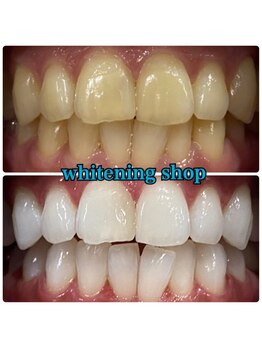 ホワイトニングショップ 天王寺店/40分照射×10回 20代女性