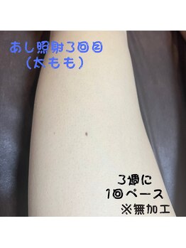 フェリッセ(FELISSE)/あし脱毛 照射3回目【K様】