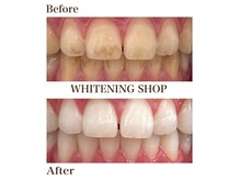ホワイトニングショップ 新宿店の雰囲気（BeforeAfter★ヤニ汚れもしっかり落とせます♪/ホワイトニング）