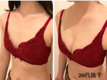 リール 新宿店(RIRE)/ 20代後半　バストアップ症例