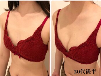 リール 新宿店(RIRE)/ 20代後半 バストアップ症例