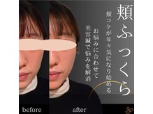チョコバリ 郡山店(chocobari)/小顔×リフトアップ(美容鍼)20代