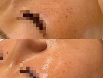 ルース 白河店(LUZ)/シミ・色素沈着症例写真