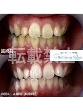 ホワイトニングサロン 熊本店 10回コース