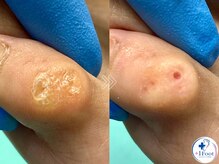 プラスワンフット 本厚木(+1 Foot)/タコ・魚の目ケア！痛みから解放