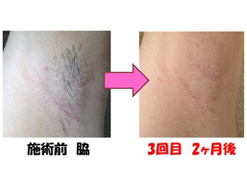 チェリオール(Cherioll)/脱毛【脇】