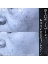 アウラプラス(Aura+)/塗るシミケア/6ヵ月