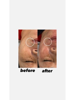 ウネ 吉祥寺(une)/お顔before/after