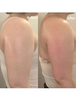 リブラ(LIBRA)/二の腕が落ちない！そんな方も！