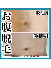 ツバキ(TSUBAKI)/メンズお腹脱毛