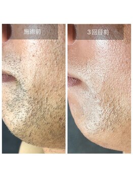 メンズ脱毛サロン レオ(REO)/ビーフォーアフター画像