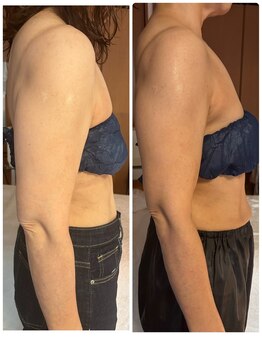 ジフィー(Gify)/二の腕集中ケア