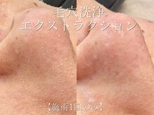 サロンドペオニー 川内店(salon de peony)の雰囲気（30代女性毛穴施術例［毛穴/小顔/シミ/フェイシャル］）