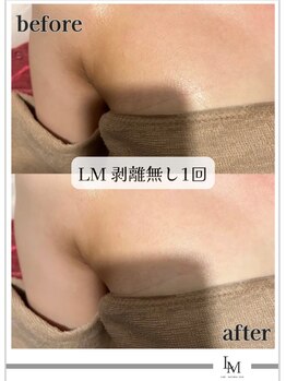 ライム 池袋東口(LIME)/Before&After　デコルテ