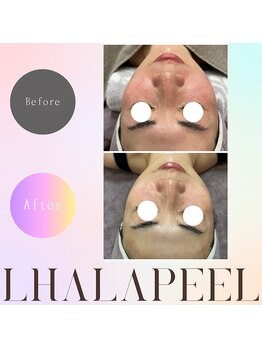 バブルビューティー(Bubble beauty)/ララピール・LDM・LED1回施術後