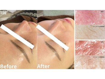 ミニョスキンラボ/韓国式ハーブピーリング5回