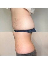 プルメリア(Plumeria)/マグニート1クール終了間際3