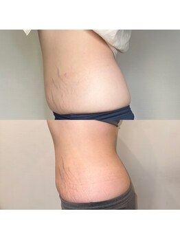 プルメリア(Plumeria)/マグニート1クール終了間際3