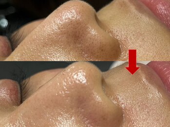 ブリリアン デイスパ 阪急西宮ガーデンズ店(BRILLIAN DAYSPA)/毛穴洗浄フェイシャル