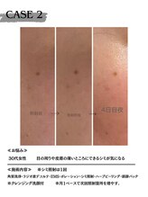 ミウル 天王寺店(miulu)/30代女性/シミ照射1回