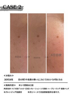 ミウル 天王寺店(miulu)/30代女性/シミ照射1回