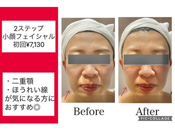 ハピネス(HAPPINESS)/2ステップ小顔フェイシャル