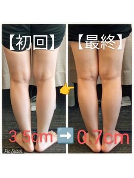 クシロ鍼灸整骨院/【O脚矯正】施術例