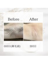 サロン ルイ(salonRui)/ワキ脱毛　before　afuta
