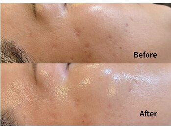 ルアーナ(Luana)/ハーブピーリング