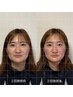 【エラ張り特化！】写真うつりが劇的変化★小顔矯正×機器体験70分12,000円→